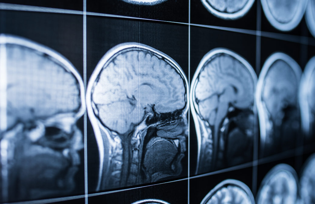 Are Traumatic Brain Injuries Common after California Car Accidents?