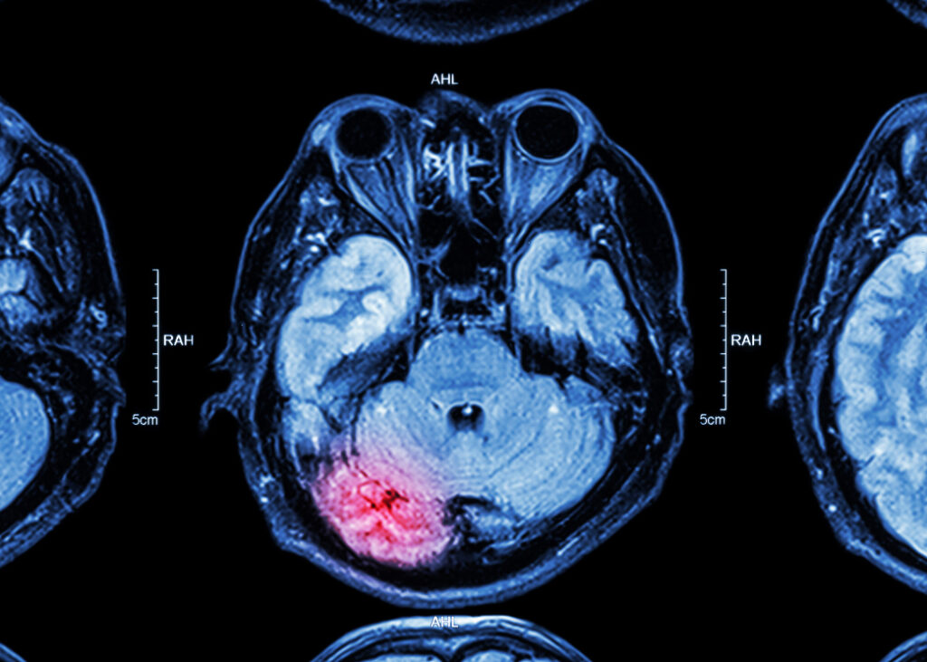 Brain x-ray imaging.